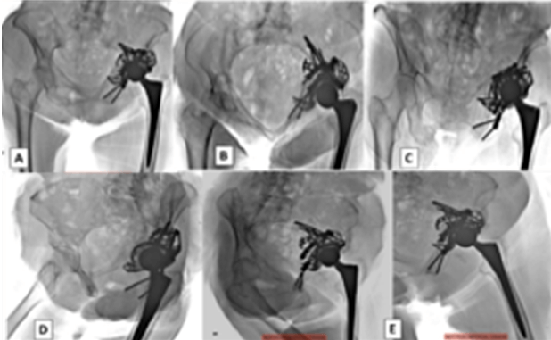 Figura 4. Radiografía control 3 años del Post Operatorio Tardía (A). Radiografía AP centrada en pubis (B). Radiografía Inlet de pelvis (C). Radiografía Outlet de pelvis (D). Radiografía Oblicua Obturatriz izquierda (E). Radiografía Oblicua alar izquierda. Se observa osteointegración y adecuada posición de los componentes de la prótesis, sin signos de aflojamiento de la prótesis.