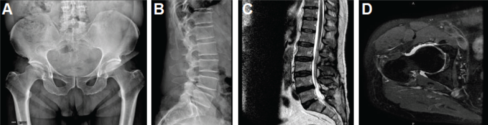 Figura 1. Imágenes al inicio del cuadro clínico. (A) Radiografía de pelvis centrada en pubis: huesos ilíacos y techo acetabular de bordes irregulares y escleróticos, esclerosis de ambas caderas, disminución de la densidad mineral. (B) Radiografía de columna lumbar: rectificación de lordosis fisiológica, con cambios osteodegenerativos regionales. (C) RMN de columna lumbar: cambios discartrósicos y espondiloartrósicos con protrusión subarticular derecha de L2L3, abombamiento discal difuso de L3-L4 y L5-S1, protrusión central de L4-L5 que condiciona estrechez del canal medular. Cambios sugestivos a laminectomía lumbar L4L5, L5-S1. (G) Artroresonancia de cadera derecha: lesión condrolabral y pinzamiento femoroacetabular tipo pincer.