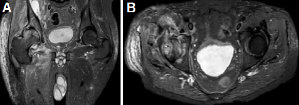 Figura 2. Imágenes al egreso de 1era Hospitalización: (A-B) RMN de cadera derecha: colecciones adyacentes al musculo iliaco derecho, con cambios inflamatorios en planos musculares del glúteo mayor y medio, femoral, abductor largo y vasto interno
