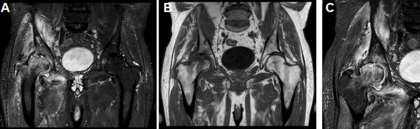 Figura 3. Imágenes al ingreso del servicio. (A,B,C) RMN de cadera derecha: componente inflamatorio/ infeccioso en articulación coxofemoral derecho. Colecciones hacia región de ilio-psoas, edema en grupos musculares adyacentes, cresta iliaca, región acetabular, cabeza y cuello de fémur, con necrosis avascular la misma.