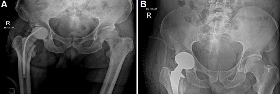 Figura 4. Imágenes postoperatorias de primer y segundo tiempo. (A) Presencia de espaciador de cemento de componente femoral derecho, gas en tejidos blandos. (B) Se evidencia de reemplazo de cadera derecha con buena relación articular coxofemoral.