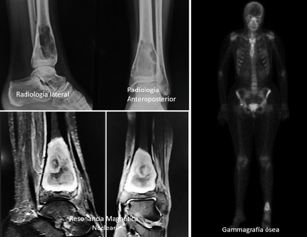 Figura 1. Estudios imagenológicos que incluyen: Radiología, Resonancia magnética de la pierna izquierda y Gammagrafía ósea, se demuestra localización y extensión de la lesión.