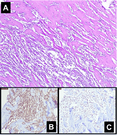 Figura 2. (A) Aspecto morfológico de la lesión. Coloración hematoxilina-eosina aumento 20x. Estudio de inmunohistoquímica: (B) Citoqueratinas de amplio espectro (CKAE1/AE3) aumento 20x. (C) p63 aumento 20x.
