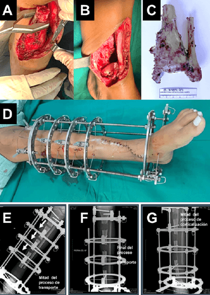 Figura 3. (A, B y C) Resección Oncológica de margen amplio, lo que incluyó el retiro en bloque de 10 centímetros de tercio distal de Tibia Izquierda. (D) Montaje del sistema de Transporte óseo (Ilizarov) utilizado en este caso con triple foco de distracción ósea. (E, F y G) Proceso de reconstrucción mediante osteogénesis por distracción culminando en artrodesis tibio-astragalina.