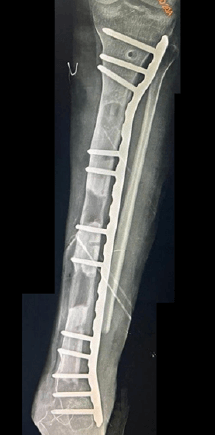 Figura 4. Conversión de Fijación externa a fijación interna para completar proceso de corticalización de la Tibia y asegurar artrodesis Tibio astragalina.
