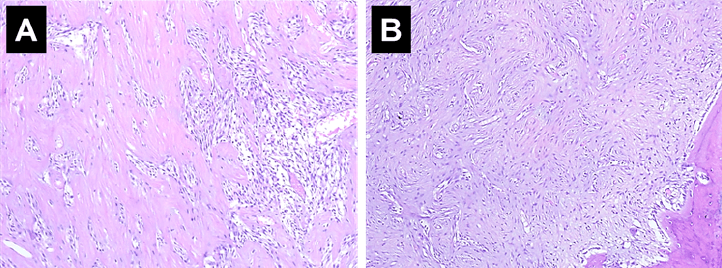 Figura 6. (A) Aspecto morfológico de la pieza quirúrgica, coloración hematoxilina – eosina, aumento 20x. Áreas similares a las observadas en la biopsia previa. (B) Aspecto morfológico, coloración hematoxilina – eosina, aumento 20x de áreas periféricas en relación a la cortical, de aspecto displasia osteofibrosa – like/displasia osteofibrosa.