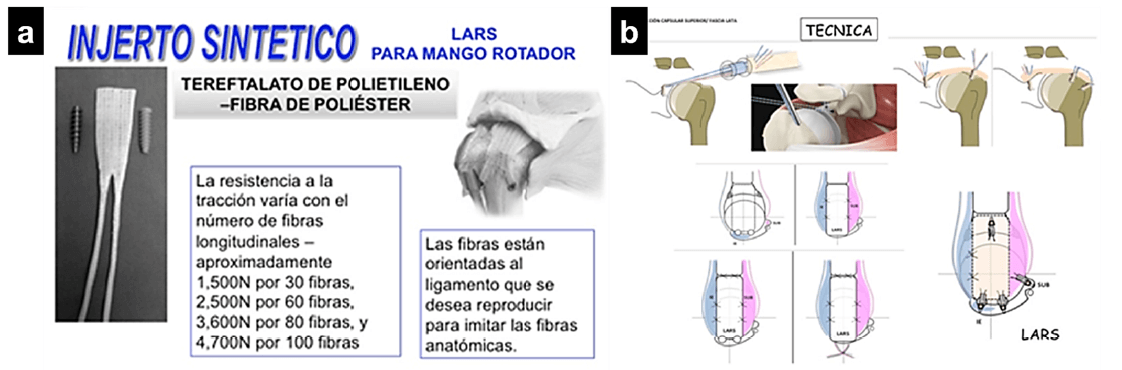 Figura 1. Descripción Injerto LARS (a); Técnica Quirúrgica (b)