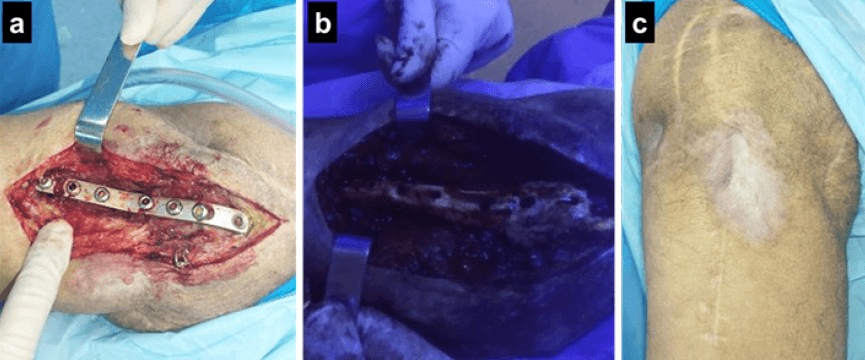 Figura 2. Paciente masculino de 32 años. Con antecedentes de PCI y operado a los 15 años, se evidencia el material (a) con osteomielitis, se retira a través de la luz de Wood (b) las zonas de captación de la doxiciclina. Se observa la curación final (c).