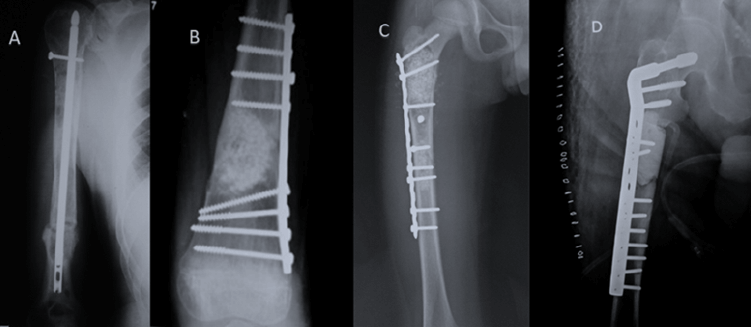 Foto 1: Casos de fracturas patológicas, intervenidos, en la Unidad de Oncología Ortopédica del Estado Monagas entre el año 2006 y el año 2019. A: Lesiones múltiples metastásicas tratadas con clavo bloqueado. B: Fractura inminente por DFC tratada con placa e injerto. C: Fractura Subtrocantérica completa tratada con placa y aloinjerto. D: Fractura Subtrocantérica por metástasis tratada con polimetilmetacrilato y material de osteosíntesis.