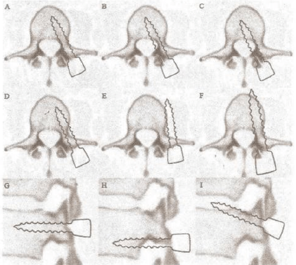 Figura 1. Clasificación de Kasim et al.21. A: Tornillo aceptablemente colocado, B: Perforación Cortical Medial (PCM) Grado 1, C: PCM Grado 2, D: Perforación Cortical Lateral (PCL) Grado 1, E: PCL Grado 2, F: Perforación Cortical Anterior (PCA), G: tornillo aceptablemente colocado en vista sagital, H: Perforación hacia el foramen, I: Perforación hacia el plato basal superior. Fuente: Kasim et al., Spine 2009,34(9): 941-948
