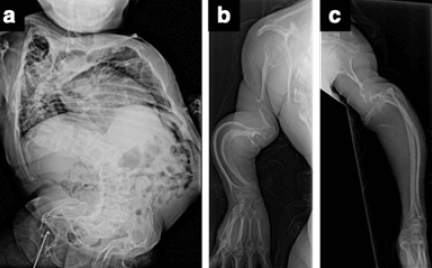 Figura 2. Columna vertebral AP (a); brazo derecho (b) y brazo izquierdo (c)