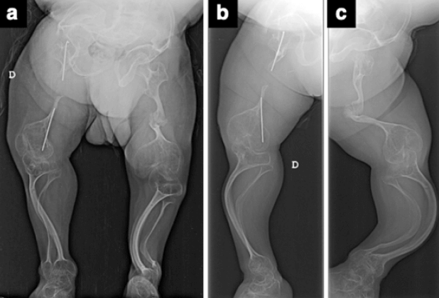Figura 3. Miembros inferiores (a); Miembro inferior derecho (b) e izquierdo (c)
