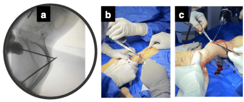 Figura 4. Demarcación de la osteotomía por fluoroscopio (a); Osteotomía percutánea de baja energía (b); y Paso de clavo de Steimann 2,0 mm intracanal (c).