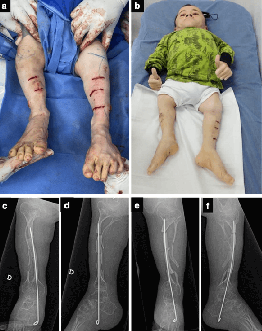 Figura 5. Fotos clínicas del post-operatorio inmediato (a) y tardío (b): Resultados post-operatorios radiológicos (c, d, e, f)