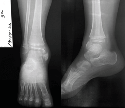 Figura 2. Se muestran radiografías en proyecciones Anteroposterior y Lateral del tobillo derecho, donde se observa masa tumoral bilobulada, unilateral, en cara anteromedial del tobillo, en relación con la epífisis distal de la tibia.