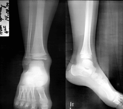 Figura 5. Radiografías con proyecciones Anteroposterior y lateral de tobillo derecho tomadas de la paciente a los 7 meses del postoperatorio, donde no se evidencian lesiones óseas.