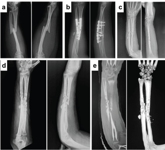 Figura 1. a: Radiografías al momento de la fractura; b: Radiografías de la operación realizada en agudo; c: Radiografías posterior a la primera limpieza quirúrgica; d: Radiografías al momento del ingreso; e: Imágenes de Tomografía computarizada.