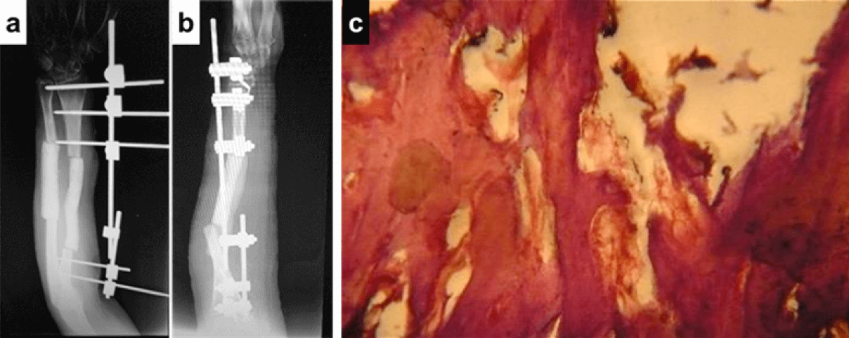 Figura 3. Primer tiempo quirúrgico: Radiografías postoperatorias en sus proyecciones anteroposterior y lateral.