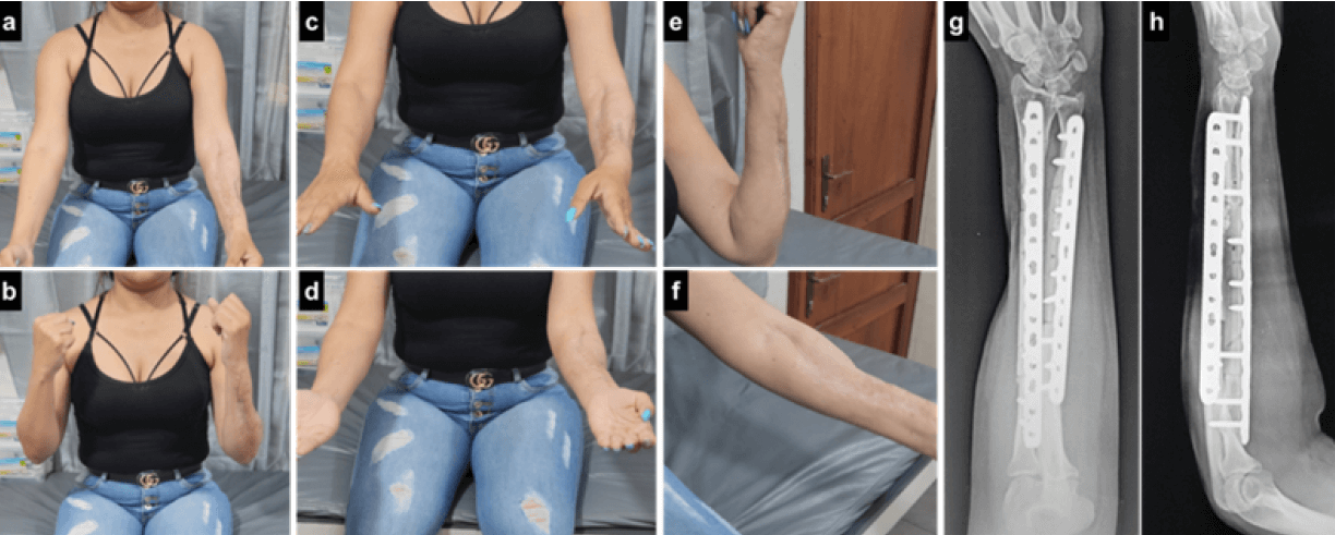 Figura 5. Evolución a largo plazo. Fotos clínicas a las 16 semanas del postoperatorio: Flexión y extensión (a, b, e y f); Pronación y supinación (c y d). Radiografías control en sus proyecciones anteroposterior y lateral a los 24 meses del postoperatorio (g y h).