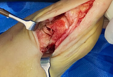 Figura 2. Corte doble en metatarsiano distal para acortar y descender la cabeza del mismo luego de queilectomía extensa.