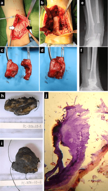 Figura 4. Fotos clínicas del intraoperatorio: Se observa la LOE del extremo distal de la tibia (flecha blanca) y la deformidad del peroné (flecha negra) aún in-situ (a); El defecto óseo resultante una vez tomadas las muestras (b); Las muestras obtenidas: separadas (c) y unidas tal y como lo estaban en el tobillo (d). Radiografías post-operatorias donde se evidencia el defecto óseo resultante de la resección-en- bloque (e, f). Imágenes macroscópicas de las muestras enviadas para biopsia (h, i). j: Imagen microscópica (j)
