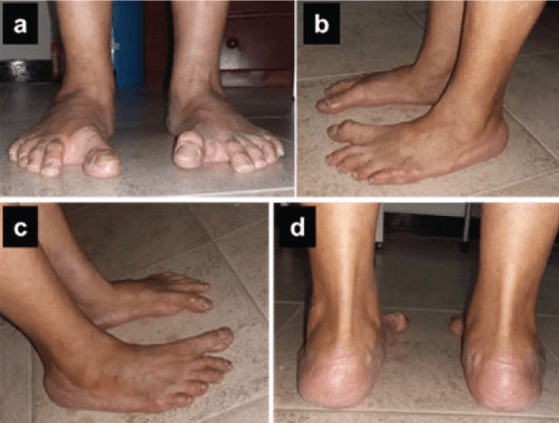 Figura 2. Evaluación preoperatoria vista frontal (a), lateral izquierda (b), lateral derecha (c) y posterior (d).