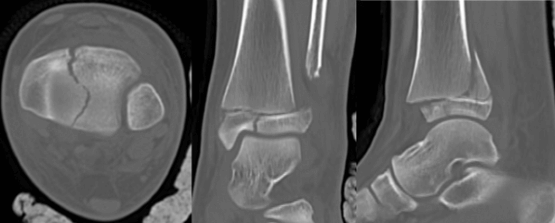 Figura 2. Tomografía computarizada de tobillo izquierdo preoperatoria en sus cortes axial, coronal y sagital.