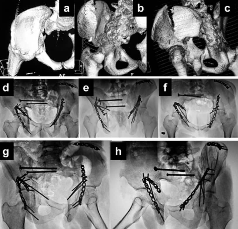 Figura 1. Paciente masculino de 23 años, posterior a arrollamiento. a, b y c: Fractura transversa de acetábulo derecho y fractura de ambas columnas de acetábulo izquierdo. Asociada a fractura de pelvis tile B con disrupción Sacro-iliaca derecha. d, e y f: Postoperatorio de 10 años. Radiografía anteroposterior, inlet y outlet de pelvis. g y h: Postoperatorio de 10 años. Radiografía Oblicua alar y Obturatriz de ambos acetábulos. Se observa, reducción anatómica, consolidación ósea, no hay desplazamiento residual de las líneas anatómicas de Judet.
