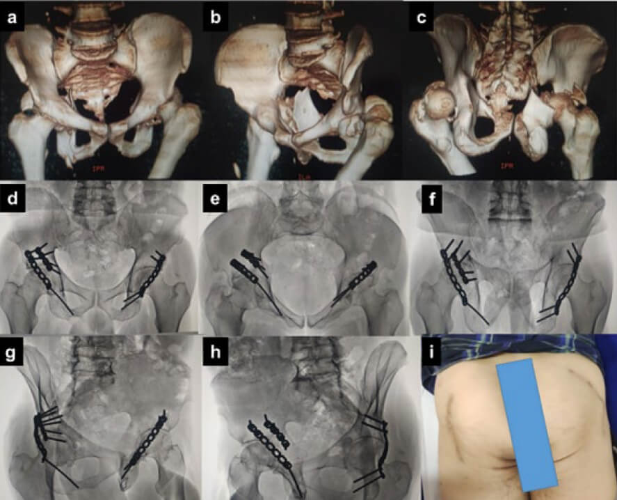Figura 2. Paciente masculino de 56 años, posterior mecanismo de aplastamiento. Imágenes a, b y c: Fractura pared posterior de acetábulo derecho y fractura de columna y pared posterior de acetábulo izquierdo. Imágenes d, e y f: Postoperatorio de 3 años. Radiografías anteroposterior, inlet y outlet de pelvis. Imágenes g, h e i: Postoperatorio de 10 años. Radiografía oblicua alar y obturatriz de ambos acetábulos. Se observa, reducción anatómica, consolidación ósea, no hay desplazamiento residual de las líneas anatómicas de Judet. Se observa cicatriz operatoria bilateral de acetábulo. Paciente con evolución satisfactoria, HHS 89 puntos.