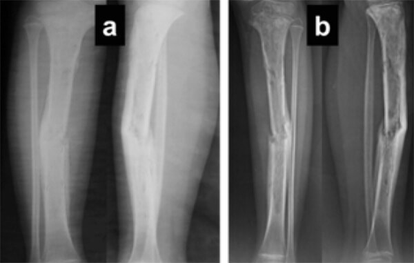 Figura 1. (a) Radiografías de la tibia derecha en su proyección anteroposterior y lateral realizadas al momento de ser referida y (b) al momento de su ingreso al Hospital Central de San Cristóbal, 2 meses después de haber iniciado su enfermedad actual.