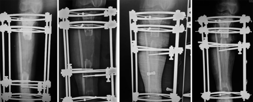 Figura 4. Secuencia de evolución del transporte óseo para la reconstrucción de 12cms de la tibia.