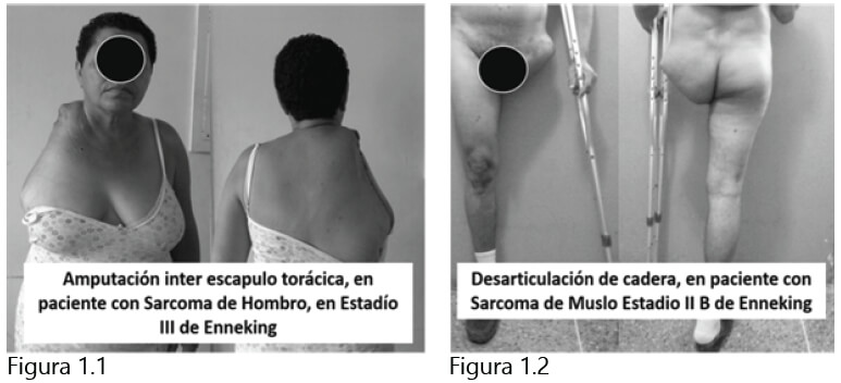 Figura 1. Dos casos intervenidos en la Unidad de Oncología Ortopédica, la primera cirugía ablativa de la extremidad superior y el segundo de la extremidad inferior, ambos casos por tumores muy proximales y voluminosos