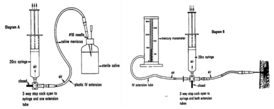 Figura 1. Método de Whitesides (8) para medir presión intracompartimental