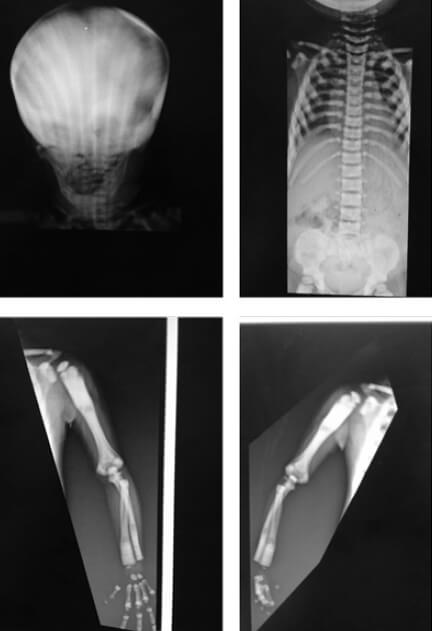 Figura 1. Radiografia de craneo en proyección anteroposterior donde se evidencia aumento de la densidad ósea. Radiografia toracoabdominal en proyección anteroposterior donde se evidencia aumento de la densidad ósea. Radiografías de miembro superior derecho e izquierdo donde se aprecia esclerosis, con imagen de “hueso dentro de hueso”, pérdida de la anatomia de la diafisis de los huesos largos y engrosamiento de las corticales.