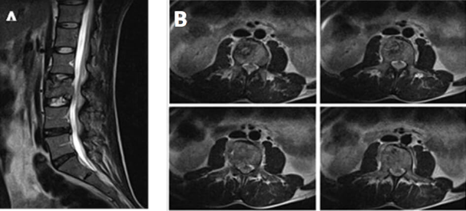 Figura 1. A. Corte sagital potenciado en T2 donde se observa alteración de la morfología del cuerpo vertebral de L3 con probable fractura patológica. B. Secuencia de cortes axiales en imagen potenciada en T2. Se observa Hiperintensidad de señal en cuerpo vertebral de L3 de bordes mal definidos que invade el canal medular y espacio foraminal del lado derecho, compatible con probable absceso.