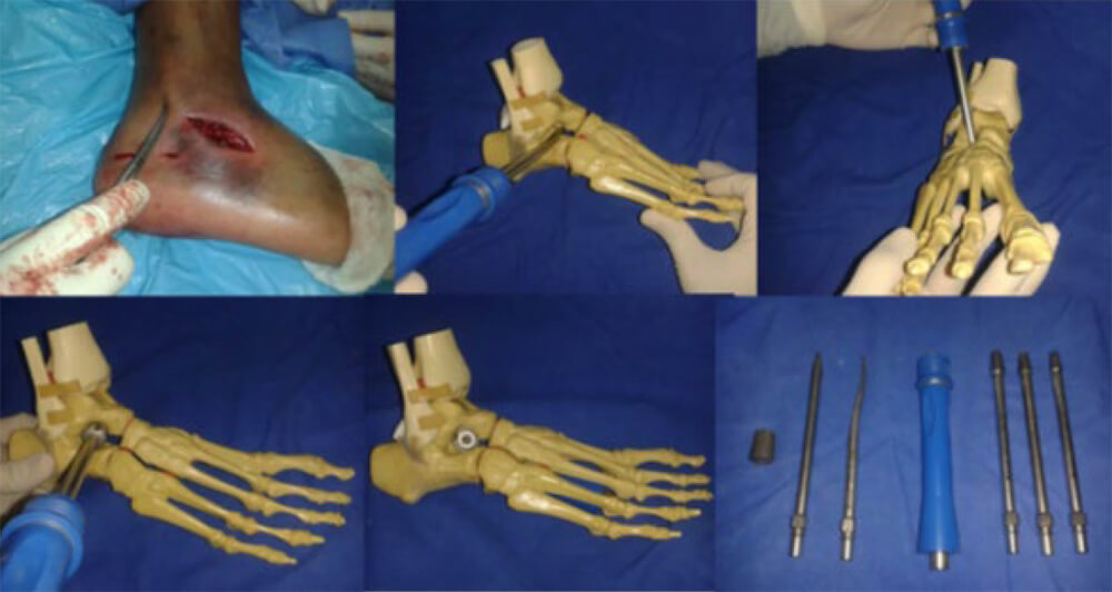 Figura 2. Técnica quirúrgica e instrumental