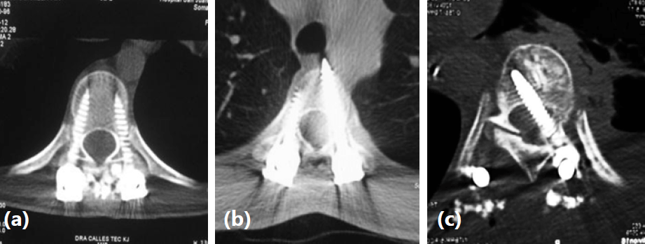 Figura 2. Imágenes tomográficas de los distinto tipos de colocación de tornillos: (a) Colocación Aceptable; (b) Perforación de la Cortical Anterior del Cuerpo Vertebral; (c) Perforación de la Cortical Medial.