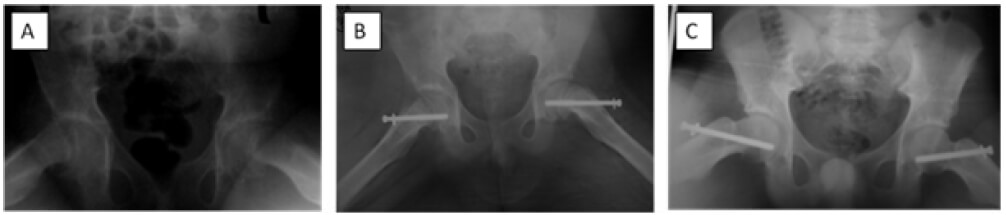 Figura 1. (A) Masculino de 15 años, epifisiolistesis bilateral. Derecha aguda, inestable con desplazamiento moderado. Izquierda crónica, estable, desplazamiento moderado. (B) Ambas caderas fueron tratadas con epifisiodesis in situ. (C) Resultados radiológicos Grado O de Boyer (10), Evaluacion funcional según Harris (9) Muy Buena. FUENTE: Archivo Digital Clínico-Radiológico LICOT-ULA.