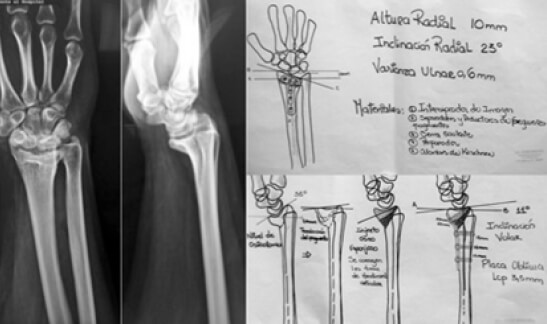 Figura 1. Técnica Quirúrgica: Planificación pre-operatoria.