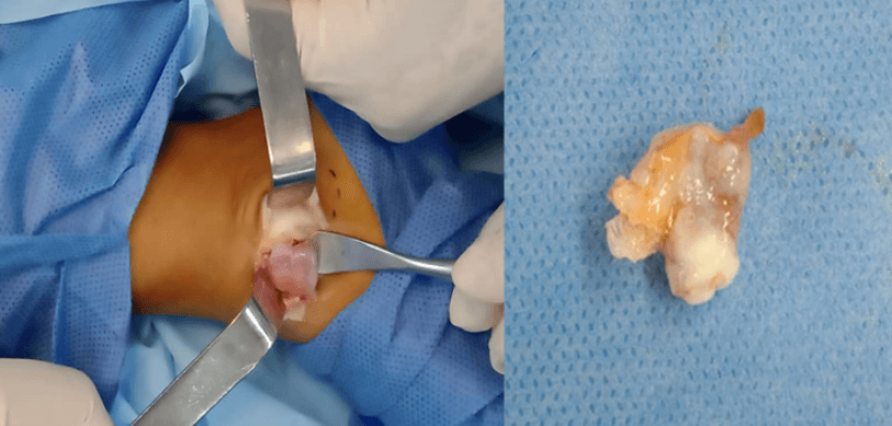 Figura 4. A la izquierda, se observa la lesión tumoral durante la toma de la biopsia excisional. A la derecha, se observa la lesión luego de ser extirpada en su totalidad.