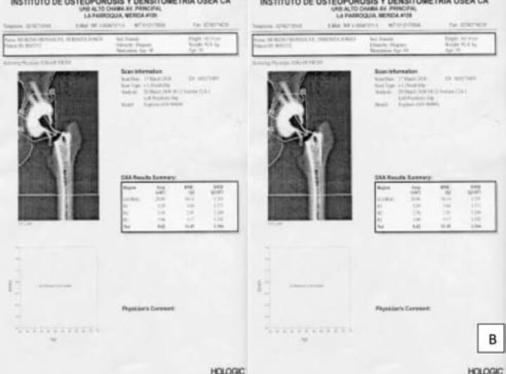 Determinación por DXA de la osteointegración de una artroplastia total de cadera. En la figura A las siete zonas de Gruen y en la B las tres medidas tomadas a nivel del acetábulo de acuerdo al protocolo de Mérida. Cortesía del Instituto de Osteoporosis y Densitometría Ósea (Mérida. Venezuela)