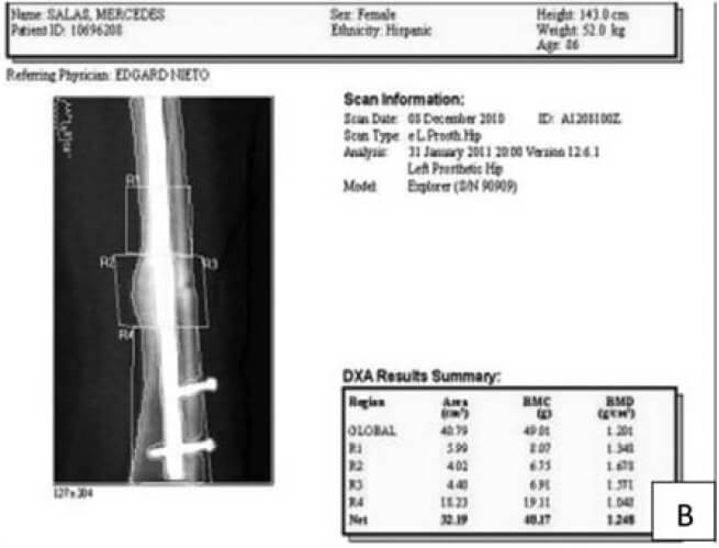 Seudoartrosis del femur distal luego de enclavamiento por fractura por estrés. Se evidencia en la B el incremento de la DMO en la cara medial, solo con tratamiento medico con combinación de anabolizantes y anticatabolicos. Cortesía del instituto de Osteoporosis y Densitometría Ósea. (Mérida. Venezuela)