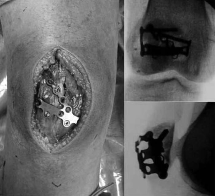 Figura N° 5. Técnica quirúrgica. Fotos del intraoperatorio.