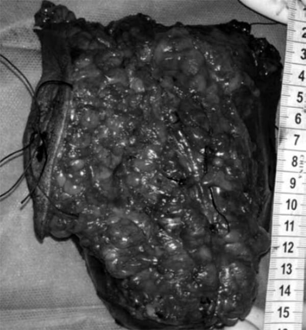 Figura N° 5. Foto clínica del intraoperatorio.Pieza anatómica tras la resección en bloque.