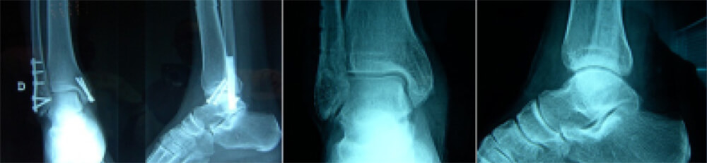Fig. 03 Paciente con 9 años de evolución. Consulta por molestias en tobillo asociada a material de síntesis. Se hace retiro de material de síntesis. A pesar del restablecimiento anatómico de la articulación. Él refiere molestia y edema vespertina ocasional y dolor leve a moderado con actividades extenuantes.