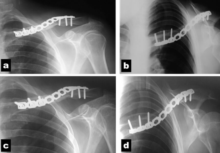 Figura 5. Resultados radiológicos en proyecciones anteroposterior y axial (Clavícula en “S”): a y b: 8 semanas de post operatorio. c y d: 12 semanas de post operatorio.