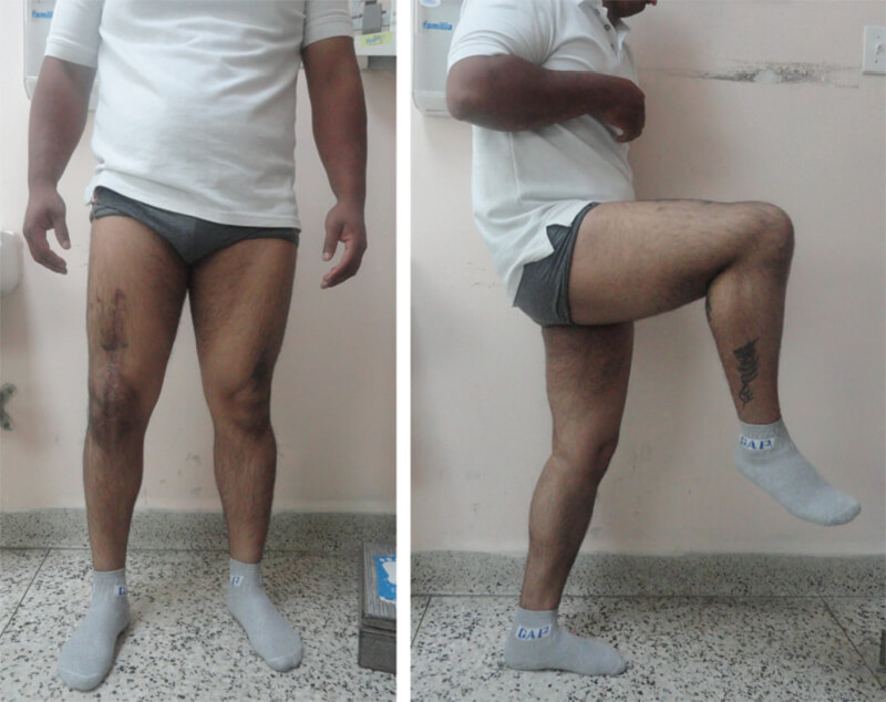 Figura 5. Fotos clínicas a 36 meses del post operatorio.