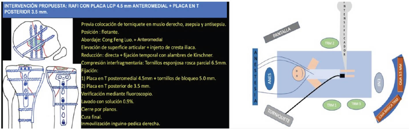 Figura 1: Planificación preoperatoria de paciente con fractura de meseta tibial