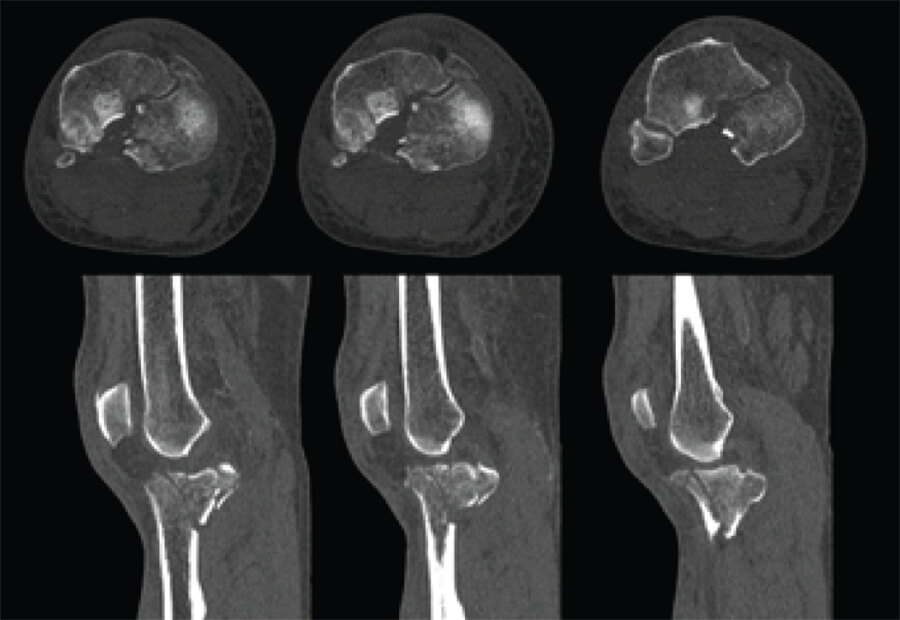 Figura 2: Cortes axiales y sagitales de fractura de meseta tibial.