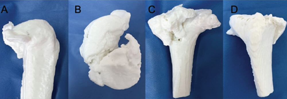 Figura 3: Fotos clínicas de la impresión 3D de tibia proximal donde se evidencian trazos de fracturas. A) visión lateral. B) visión axial.C) visión posterior. D) visión anterior.